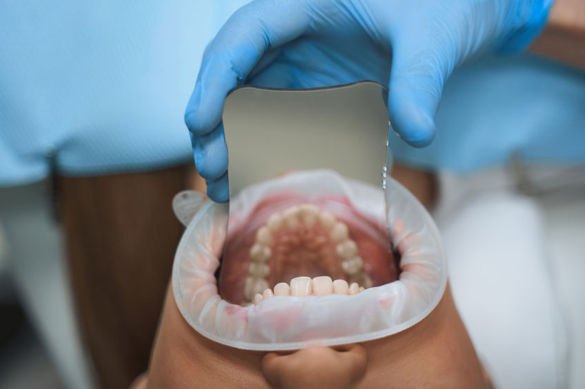 dental-crowns-in-turkey Dental crowns in Turkey
